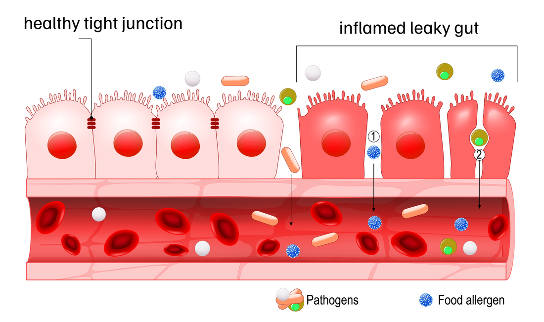 Leaky Gut: The Hidden Culprit Behind Your Digestive Issues