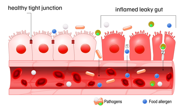 Leaky Gut: The Hidden Culprit Behind Your Digestive Issues